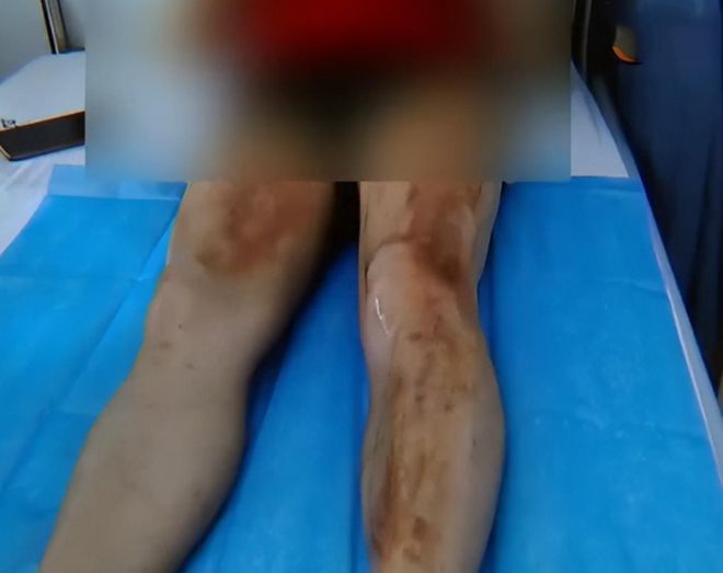 必威冷水壶烫伤老人家属索赔10000元厂家:我让你往里放烫水的(图2) 必威冷水壶烫伤老人家属索赔10000元厂家:我让你往里放烫水的(图2)